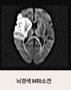 뇌경색 MRI소견